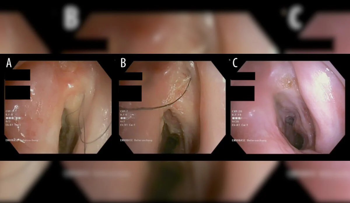 Austrian Man Develops Hair in Throat Due to Smoking