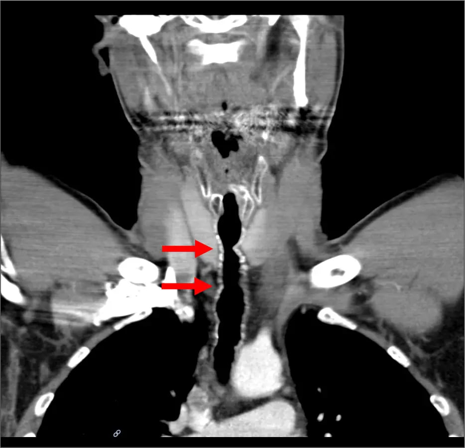 Austrian Man Develops Hair in Throat Due to Smoking